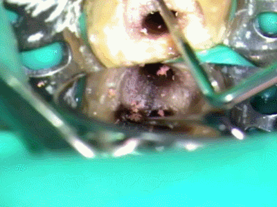 ガッタパーチャ除去 2014.08.19.gif